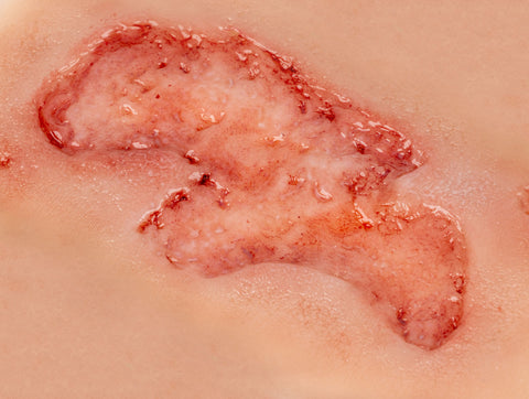 Rană simulator ulcer arterial la picior, mic, faza de epitelizare