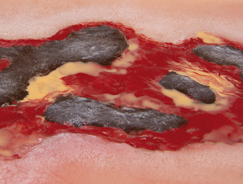 Rană simulator ulcer arterial la picior, mare, faza de exudare