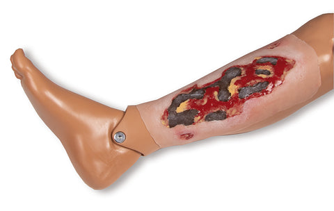 Wound moulage arterial leg ulcer, large, exudation phase