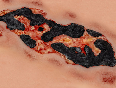 Rană simulator ulcer arterial la picior, mare, faza de exudare