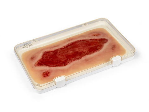 Moulage ulcer arterial la picior, mare, fază de granulație