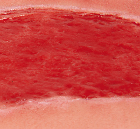 Moulage ulcer arterial la picior, mare, fază de granulație