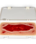 Moulage ulcer arterial la picior, mare, fază de granulație