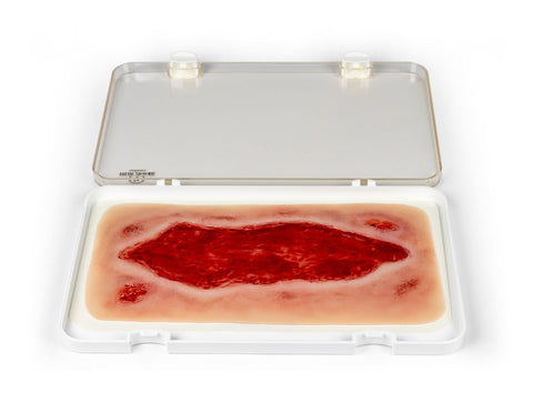 Moulage ulcer arterial la picior, mare, fază de granulație