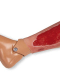 Moulage ulcer arterial la picior, mare, fază de granulație