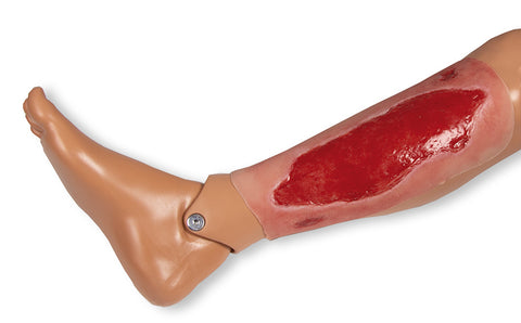 Wound moulage arterial leg ulcer, large, granulation phase