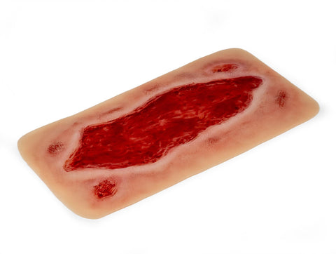 Moulage ulcer arterial la picior, mare, fază de granulație
