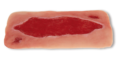 Moulage ulcer arterial la picior, mare, fază de granulație