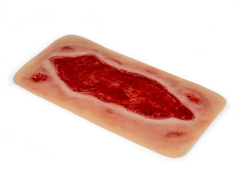 Moulage ulcer arterial la picior, mare, fază de granulație