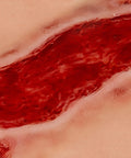 Moulage ulcer arterial la picior, mare, fază de granulație