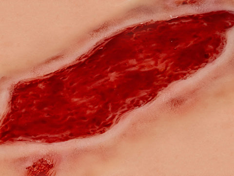 Moulage ulcer arterial la picior, mare, fază de granulație