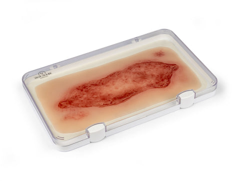 Rană simulator ulcer arterial la picior, mare, faza de epitelizare
