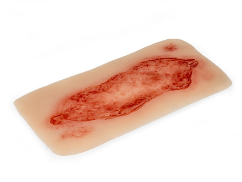 Rană simulator ulcer arterial la picior, mare, faza de epitelizare