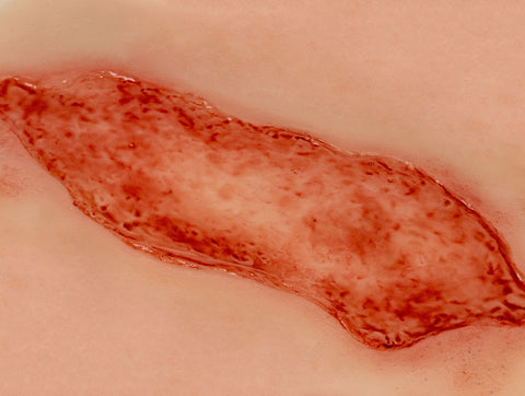 Rană simulator ulcer arterial la picior, mare, faza de epitelizare