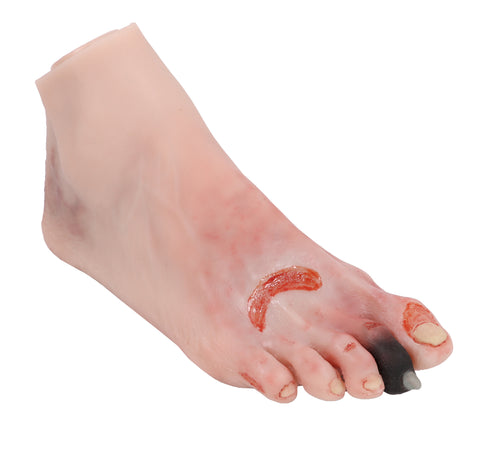 Wound foot with diabetic foot syndrome