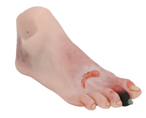 Wound foot with diabetic foot syndrome