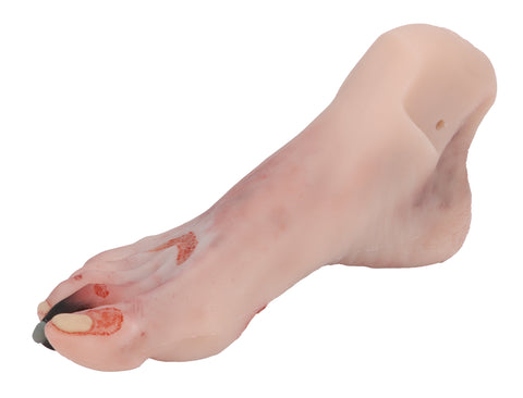 Wound foot with diabetic foot syndrome