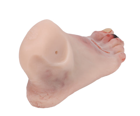 Wound foot with diabetic foot syndrome