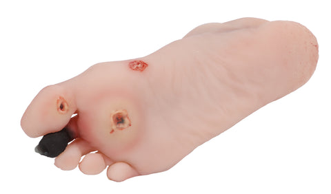 Wound foot with diabetic foot syndrome