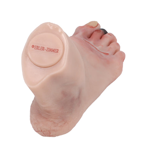 Wound foot with diabetic foot syndrome