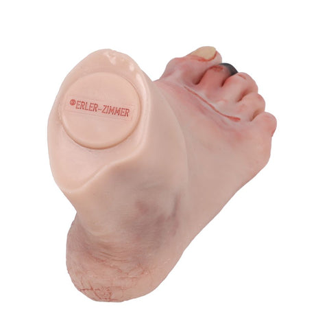 Wound foot with diabetic foot syndrome