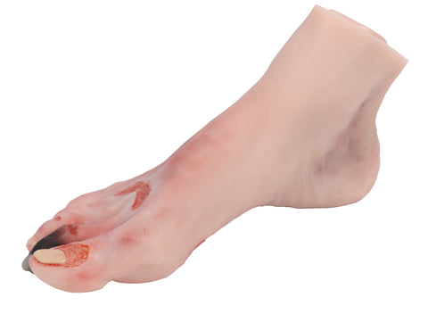 Wound foot with diabetic foot syndrome