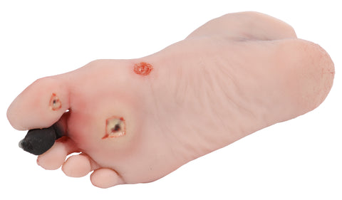 Wound foot with diabetic foot syndrome