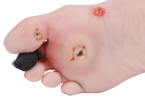 Wound foot with diabetic foot syndrome