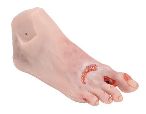 Wound foot with diabetic foot syndrome, severe stage, manikin version