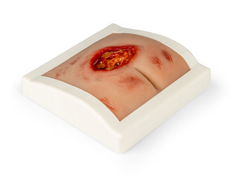 Moulage rană decubit sacral, curățat, inclus stand