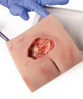 Moulage rană decubit sacral, curățat, inclus stand