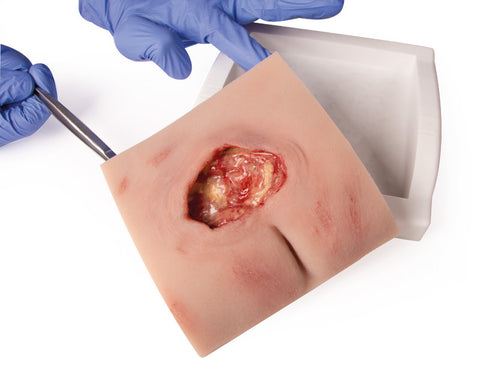 Wound moulage sacral decubitus, cleaned including stand