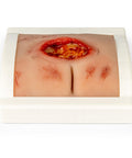 Moulage rană decubit sacral, curățat, inclus stand