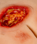 Moulage rană decubit sacral, curățat, inclus stand