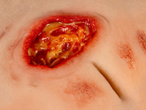 Moulage rană decubit sacral, curățat, inclus stand