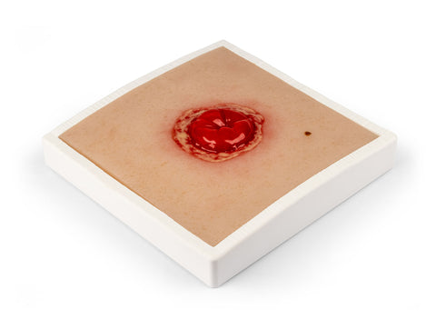 Moulage rană colostomă cu inflamație, inclus stand
