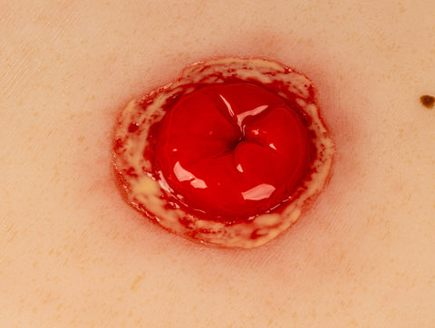 Moulage rană colostomă cu inflamație, inclus stand
