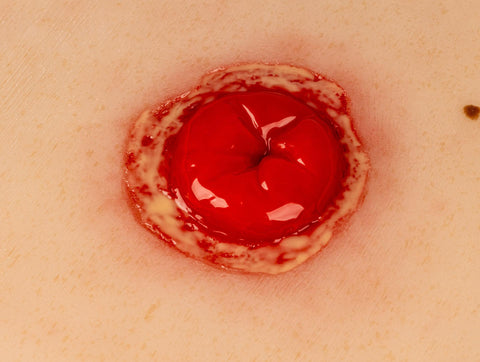 Moulage rană colostomă cu inflamație, inclus stand