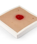 Moulage rană colostomă sub nivelul pielii, incluzând suport