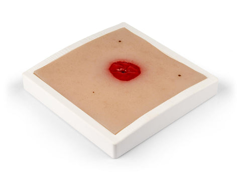 Moulage rană colostomă sub nivelul pielii, incluzând suport