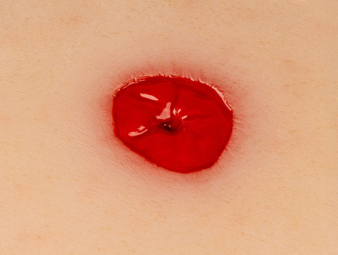 Moulage rană colostomă sub nivelul pielii, incluzând suport