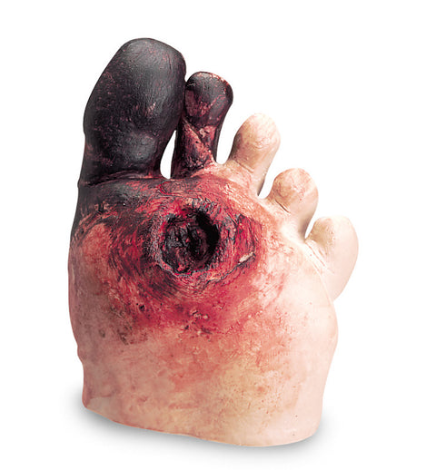 Unhealthy foot model