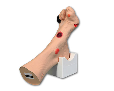 Wound Foot â€œWilmaâ€