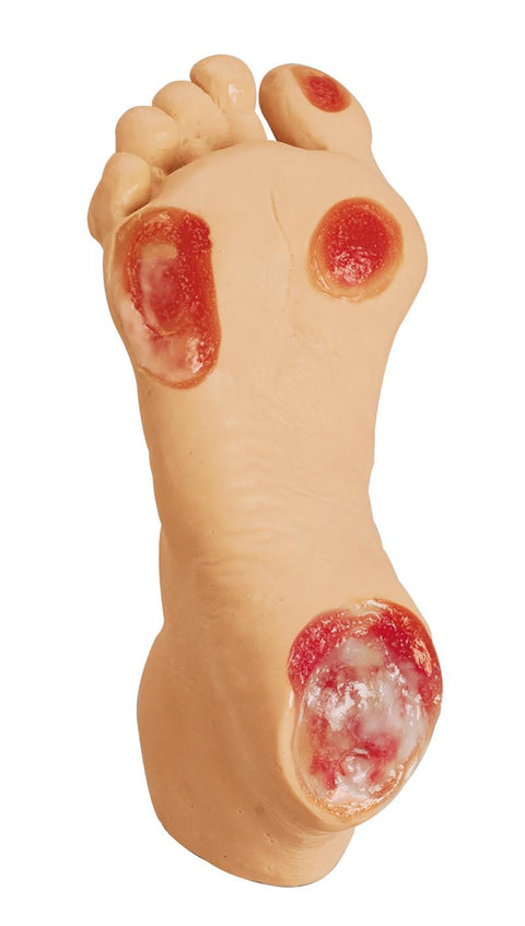 Picior cu ulcer de presiune la vârstnici