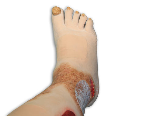 Vinnie Venous Insufficiency Leg