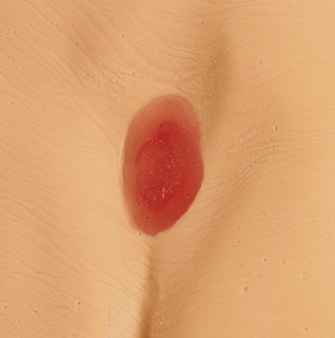 Modele de ulcer de presiune / plagă de pat