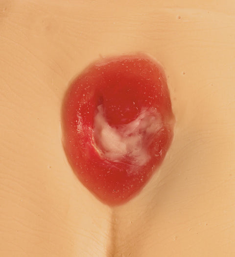 Modele de ulcer de presiune / plagă de pat