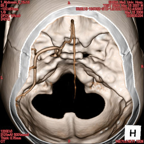 Model de cap angiografic