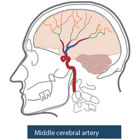Model de cap angiografic