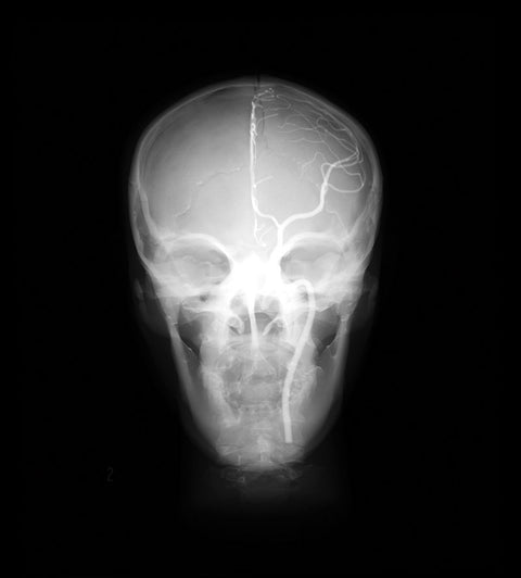 Model de cap angiografic